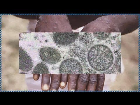 Minnesota reports its first presumptive case of monkeypox