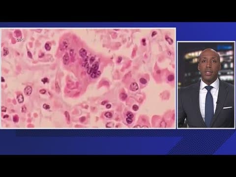 Person with measles travels through DC airports, health experts warn of possible exposure