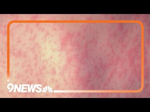 Health expert explains what you need to know about measles
