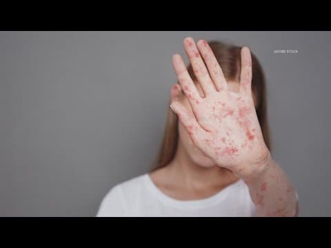 More measles cases confirmed in Texas, bringing outbreak total to 58