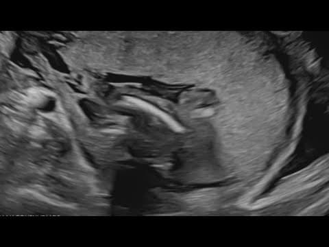 One fifth of abortions in Colorado are for Texas women traveling to obtain procedure, data shows