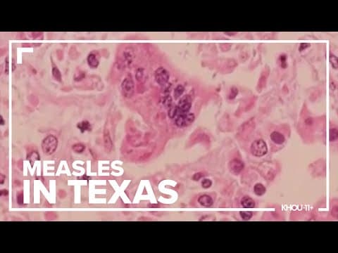 Measles Q&A: Your questions answered as the disease spreads in Texas
