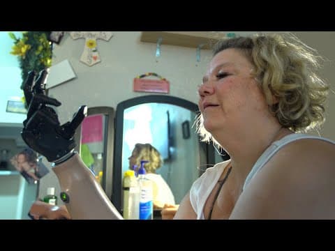 Quadruple amputee received a "helping hand" to feel normal again
