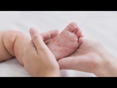 State officials to provide updates on Texas measles outbreak