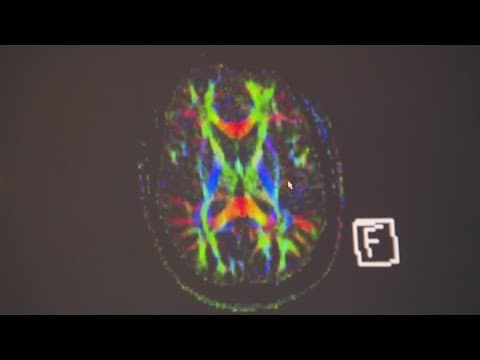 Rethinking recovery: New concussion treatment helps young athletes heal faster