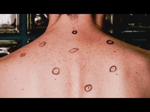 It's Melanoma Monday! Here's how to check your cancer risk