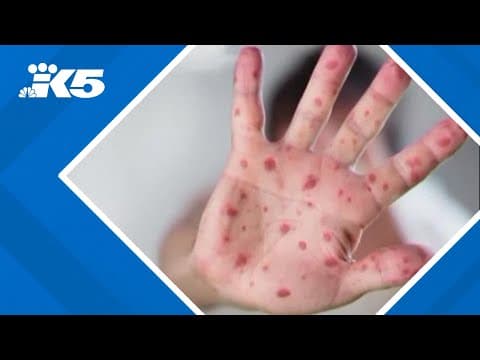 Measles outbreak continues to grow in Texas