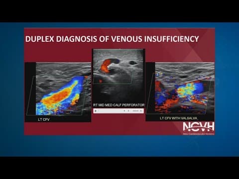What is chronic venous insufficiency?