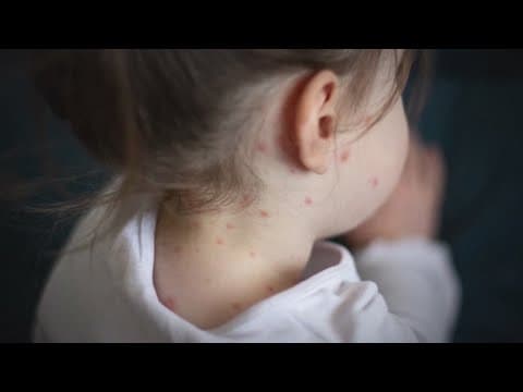 Texas health department now reporting measles outbreak in South Plains, Panhandle regions