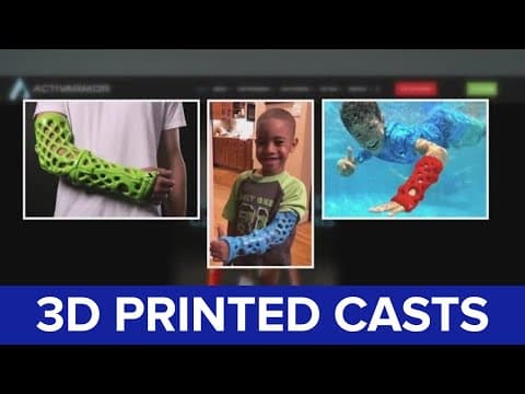 First Louisiana patient gets a 3D-printed, custom-fit cast