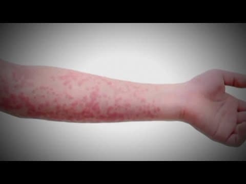 Measles cases in the US continue to rise after already reaching highest count in 30 years