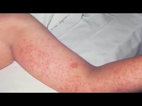 Health experts warn of measles spread ahead of summer vacation activities