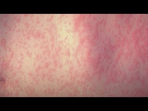 Measles outbreak latest updates