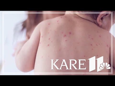 The measles wave hasn't seen a case in 2 weeks, and public health officials say that's partially due