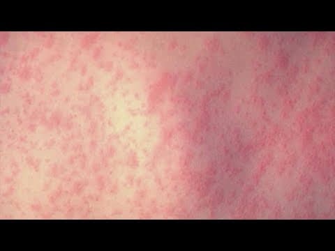 Fort Bend County confirms its first case of measles this year