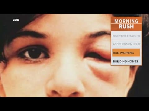 CDC warns of disease spread by a bug