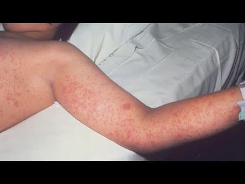 Texas measles outbreak: Cases continue to spread