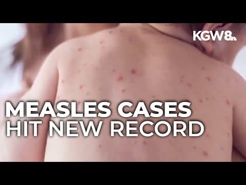 US reports highest number of measles cases