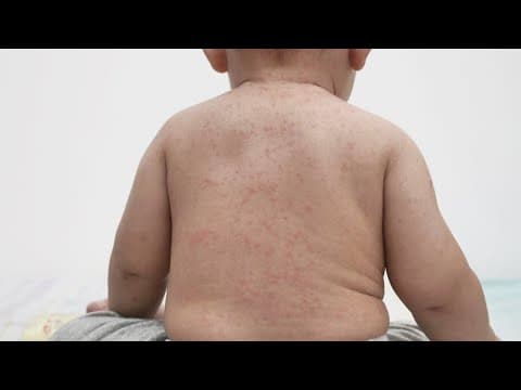 Measles outbreak in West Texas worsens