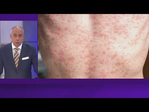 More than 120 measles cases reported in South Plains region of Texas