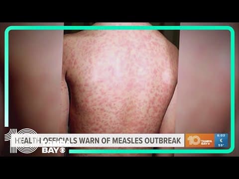 Florida health officials warn of measles outbreak