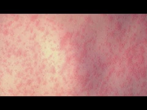 Concern grows for West Texas measles outbreak