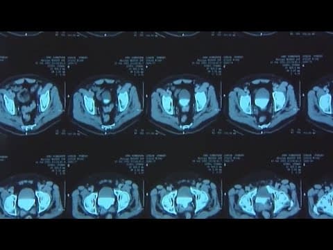 More people under 50 are diagnosed with cancer, doctors say