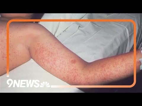 Measles outbreak growing in Utah, Arizona