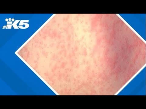 U.S. measles cases passes 1,000