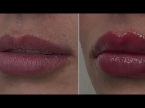 The Cosmetic Fillers Boom: What Are the Side Effects?