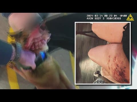 10Investigates: K-9 bite leaves woman with scars in Knox County
