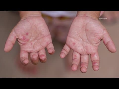 More measles cases reported in Texas: Latest data and everything we know