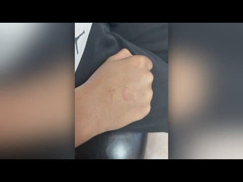 North Texas students gave each other temporary tattoos with the same needle, officials say