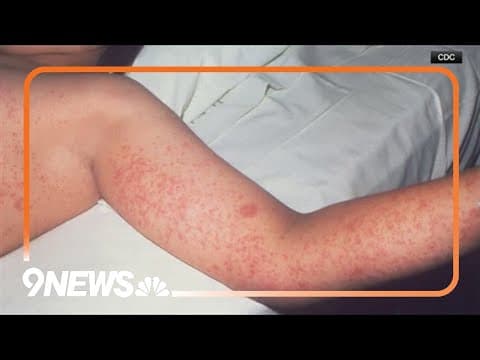 Funding cuts impacting measles outbreak, CDC scientist says