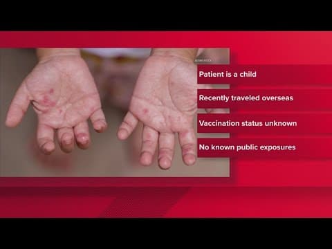 Another North Texas county reports second measles case this year, officials say