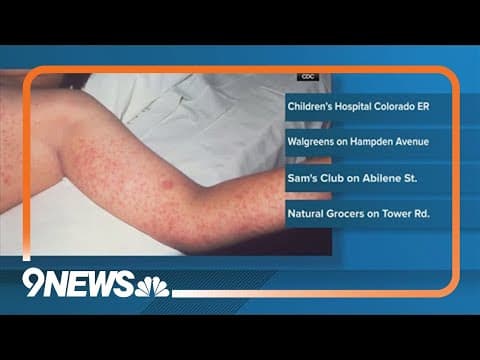 Child confirmed to have measles, exposure warning at Aurora locations