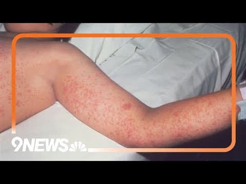 Doctors concerned over measles outbreak