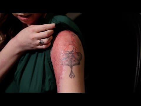 Dallas couple sues bar after fiery drink explodes, leaving them with scarring 3rd-degree burns