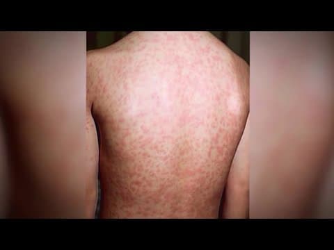 Measles outbreak raises concerns amid carnival festivities