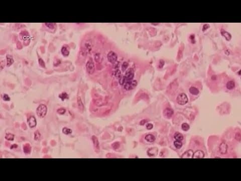 Texas measles outbreak: What we know after first measles death in the U.S. in a decade