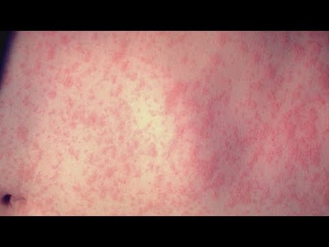 Rise in US measles cases could prompt change in status