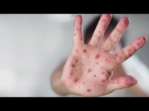 Indiana's 1st confirmed measles case of 2025 concerns pediatricians