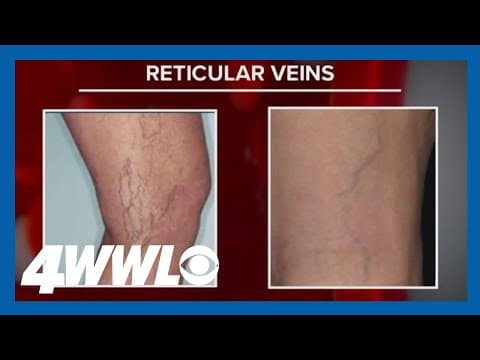 Treatable leg vein conditions often not diagnosed
