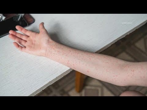 Texas health officials say Mexia ISD report of Rubella not accurate