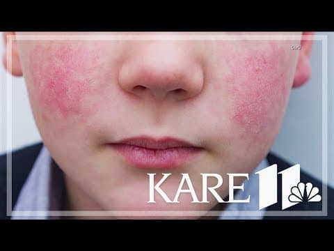 CDC warning about rise in parovirus cases