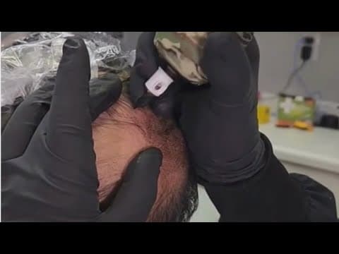 How those suffering from alopecia are getting their confidence back