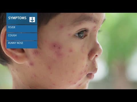Measles outbreak reported in West Texas