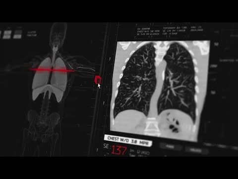 Closing the gap, catching lung cancer early