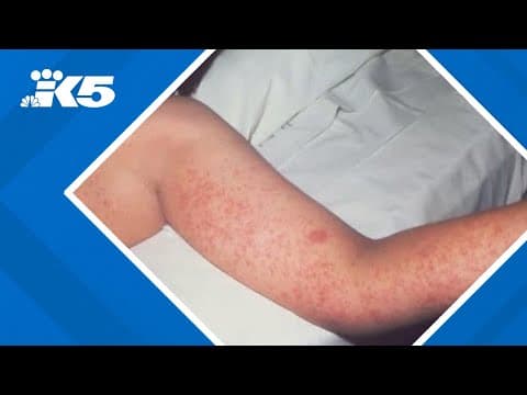 800 confirmed measles cases in the U.S. so far this year, CDC confirms