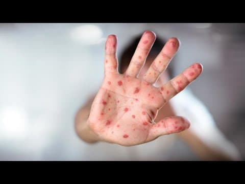 2 more cases of measles reported in Indiana